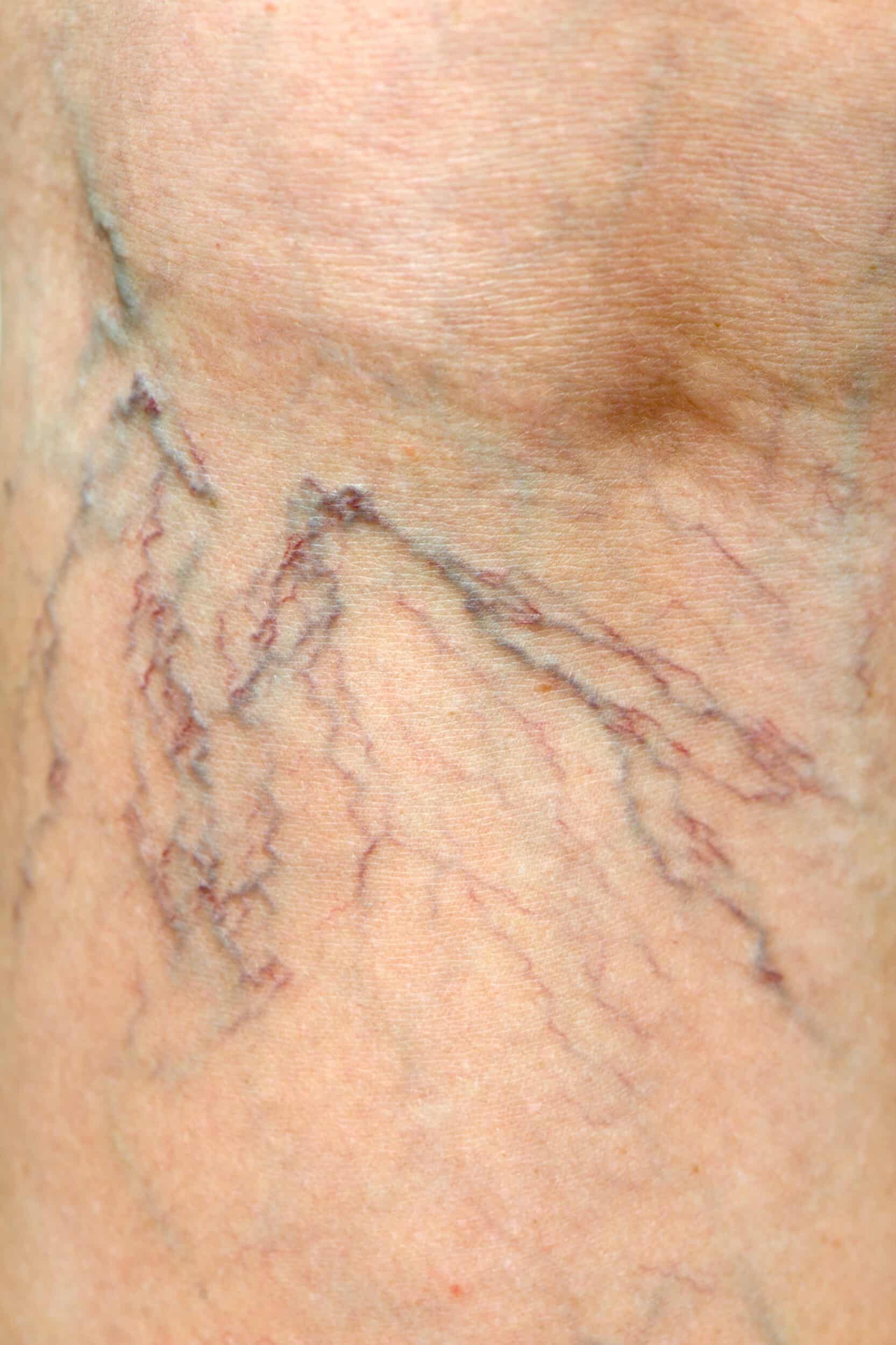 Close up of Human Spider Veins on Leg