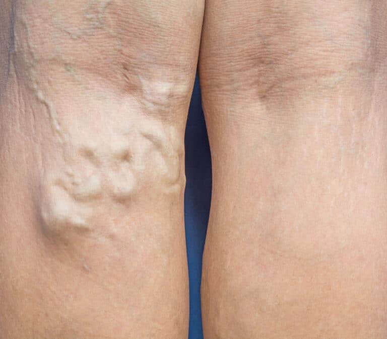 Varicose veins in the legs