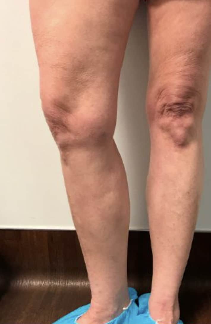 After Image: Varicose Veins - front