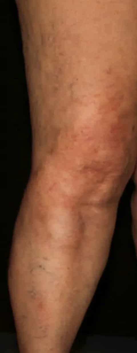 After Image: Varicose Veins - front