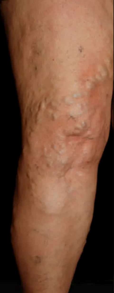 Before Image: Varicose Veins - front