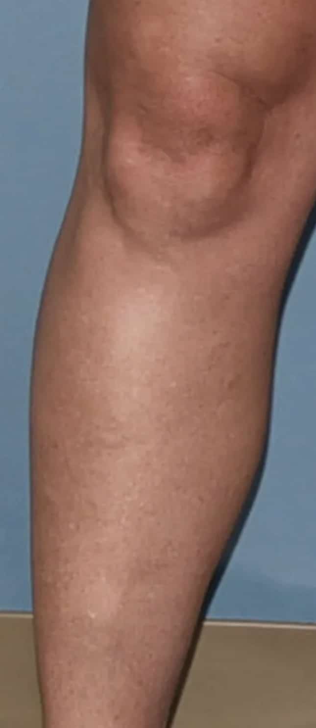 After Image: Varicose Veins - front