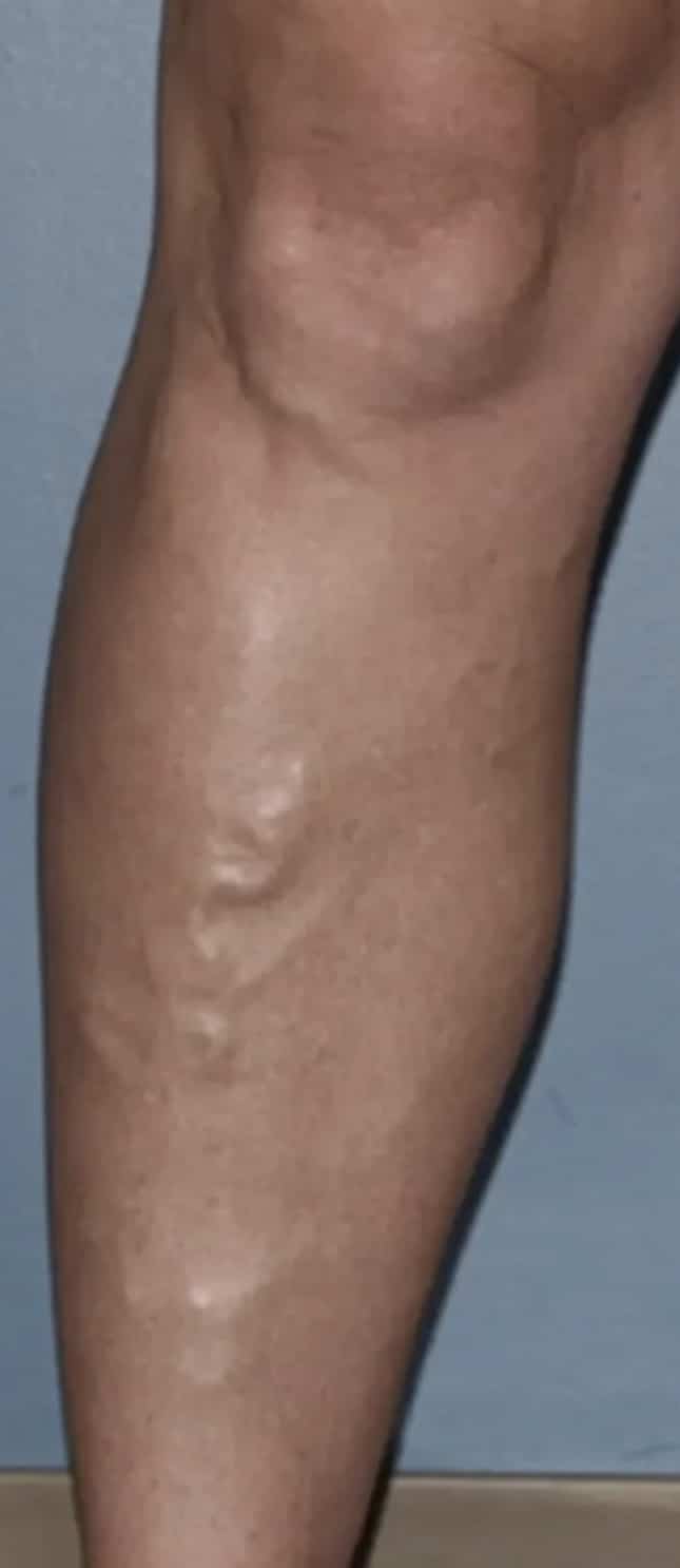 Before Image: Varicose Veins - front