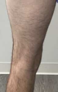 After Image: Varicose Veins