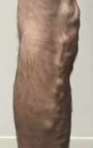 Before Image: Varicose Veins