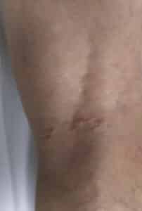 After Image: Varicose Veins