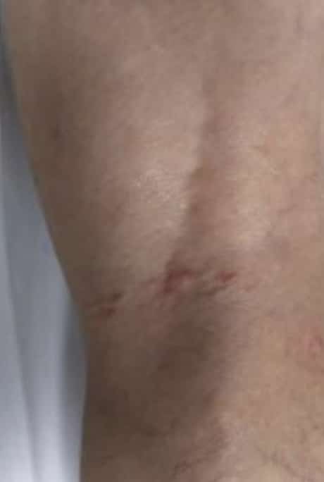 After Image: Varicose Veins - back