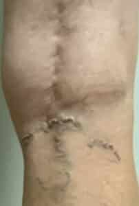 Before Image: Varicose Veins