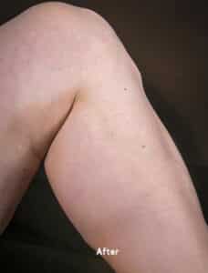 After Image: Spider Veins