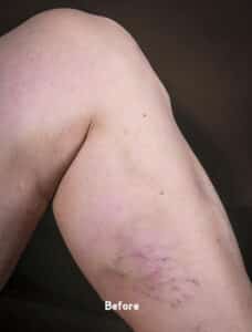 Before Image: Spider Veins