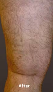 After Image: Varicose Veins