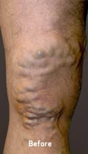 Before Image: Varicose Veins