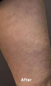 After Image: Spider Veins