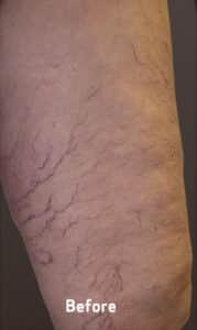 Before Image: Spider Veins