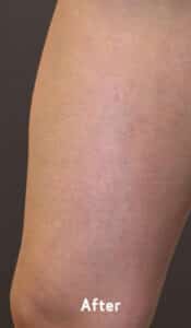 After Image: Varicose Veins