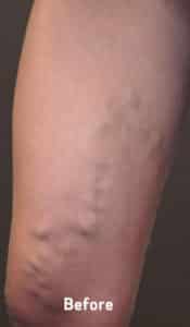 Before Image: Varicose Veins