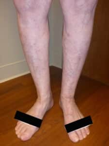 After Image: Large Vein Disease