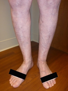 After Image: Large Vein Disease - front