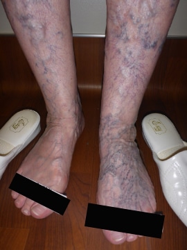 Before Image: Large Vein Disease - front