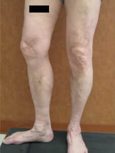 After Image: Large Vein Disease