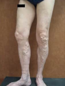 Before Image: Large Vein Disease