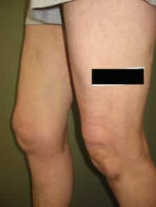 After Image: Large Vein Disease