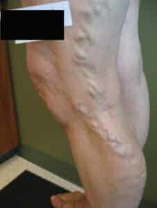 Before Image: Large Vein Disease