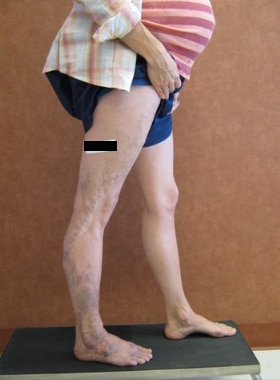 Before Image: Pregnancy - right-side