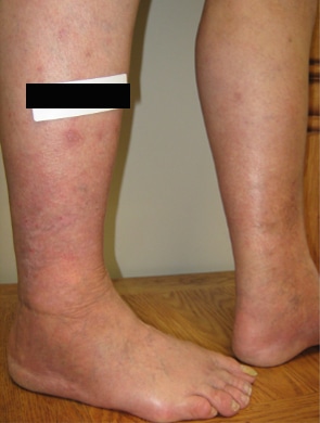 After Image: Ulcer - right-side