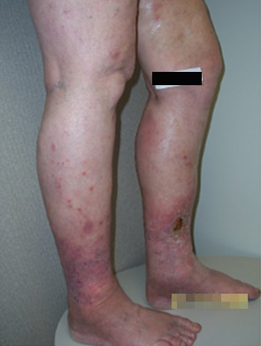 Before Image: Ulcer - right-side