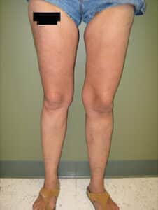 After Image: Large Vein Disease