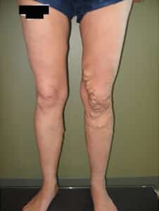 Before Image: Large Vein Disease