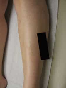After Image: Spider Veins