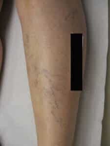 Before Image: Spider Veins