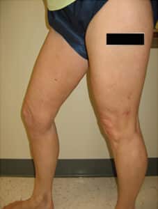 After Image: Spider Veins