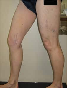 Before Image: Spider Veins
