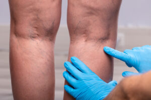 Gloved hand points to a varicose vein in Geneva, IL, doctor's office