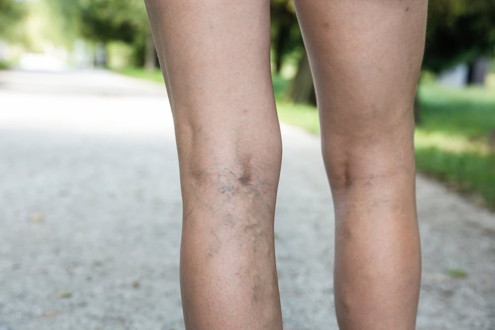 Woman with tired legs in Geneva, IL