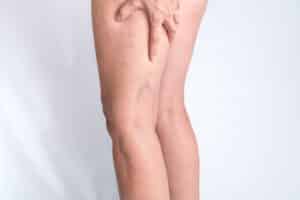 Woman with varicose veins in Aurora, IL