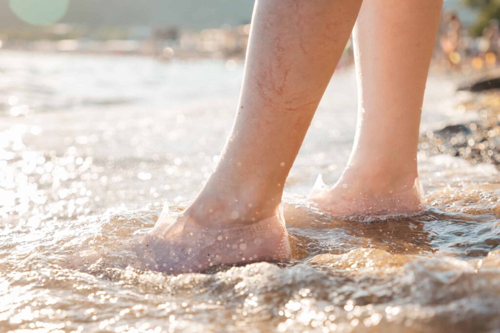 Varicosity.,A,Woman,Stands,On,The,Beach,In,The,Water A woman with spider veins on her legs stepping barefoot in the water