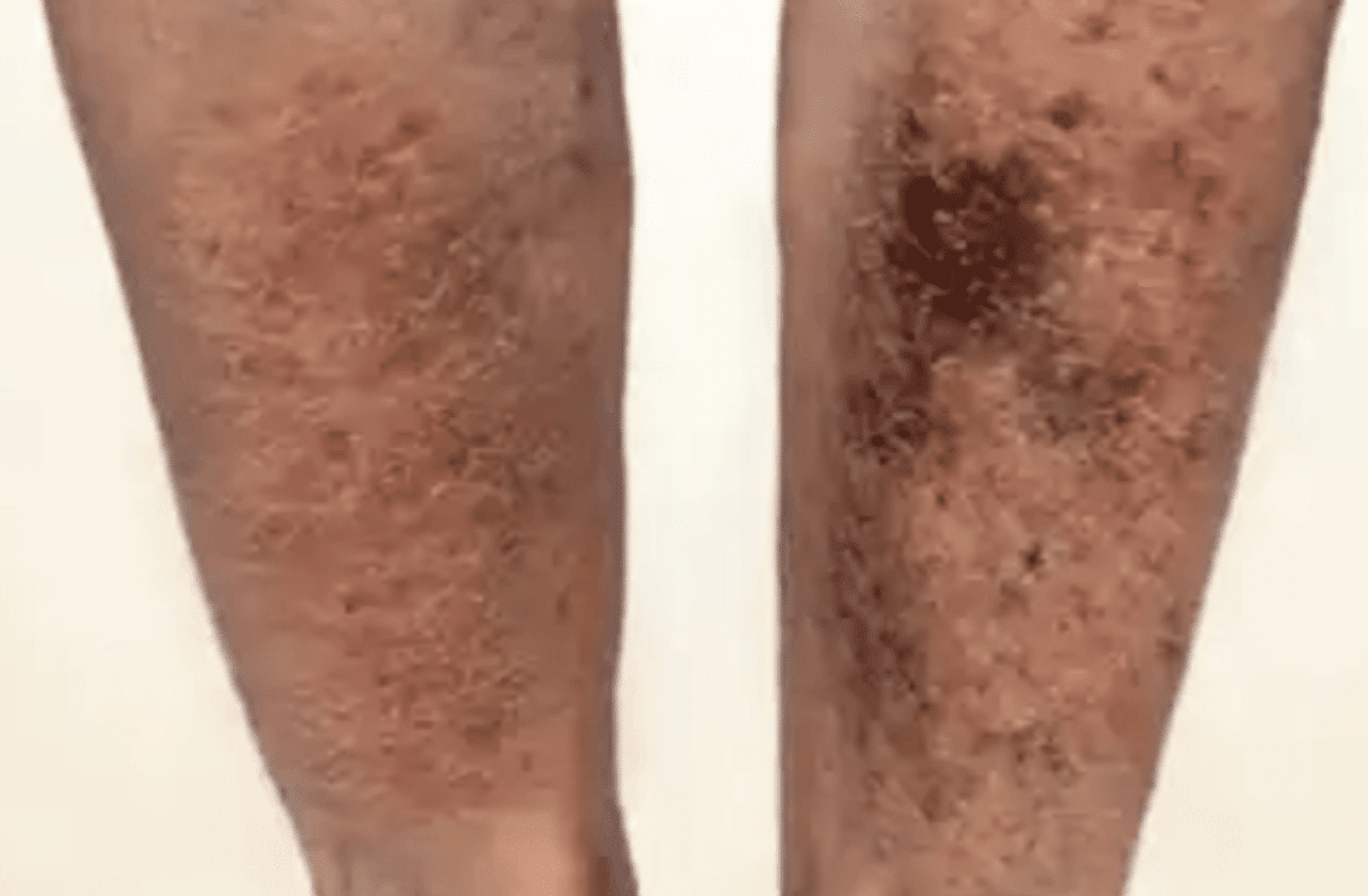 1773325130_Screenshot-2023-08-16-at-1.03.46-PM Leg Ulcer Treatment Batavia IL