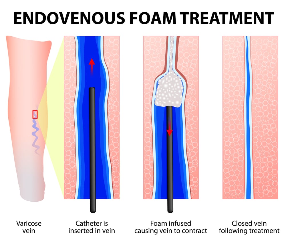 Foam,Sclerotherapy.,Sclerofoam