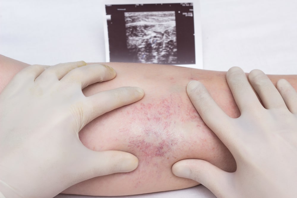 A,Doctor,In,Gloves,Examines,The,Veins,And,Legs,Of Vein Disease Diagnosis in Geneva & Elk Grove Village, IL