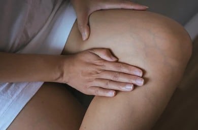 Woman examines her spider veins on her leg.